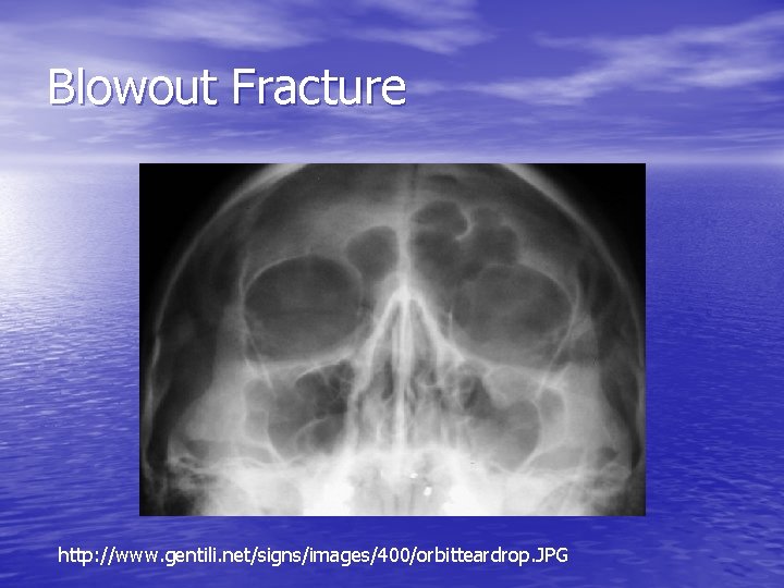 Blowout Fracture http: //www. gentili. net/signs/images/400/orbitteardrop. JPG 