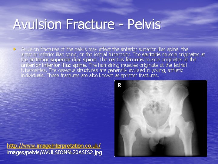 Avulsion Fracture - Pelvis • Avulsion fractures of the pelvis may affect the anterior