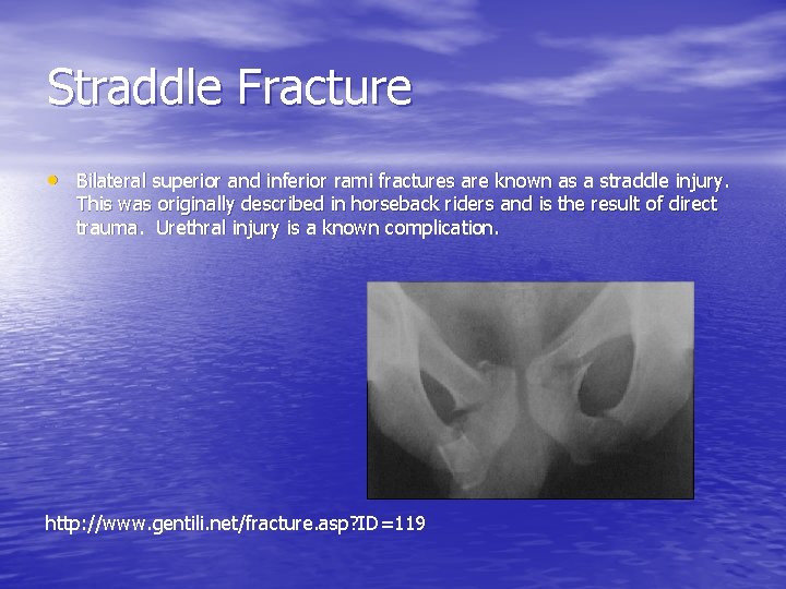 Straddle Fracture • Bilateral superior and inferior rami fractures are known as a straddle