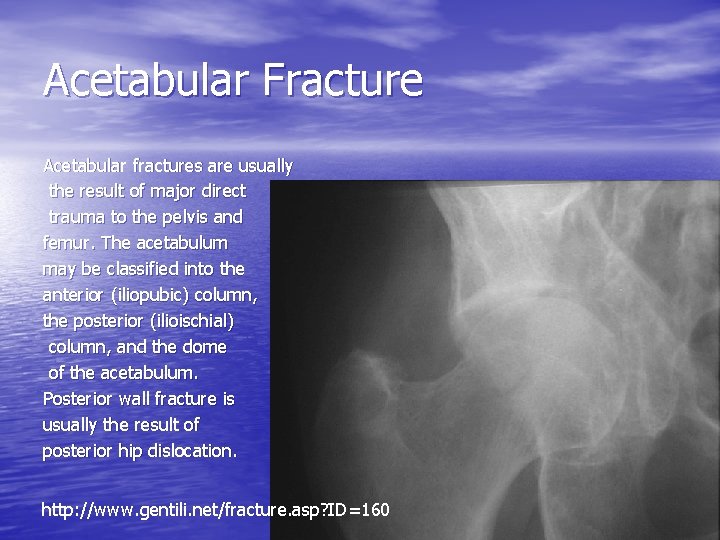 Acetabular Fracture Acetabular fractures are usually the result of major direct trauma to the