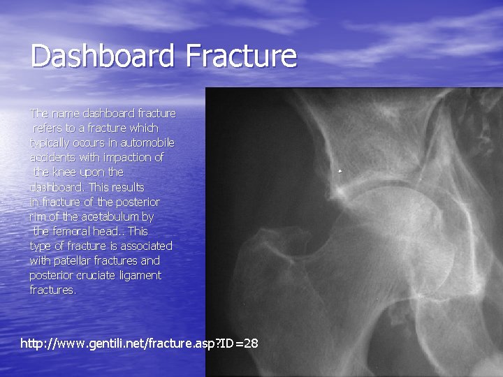 Dashboard Fracture The name dashboard fracture refers to a fracture which typically occurs in