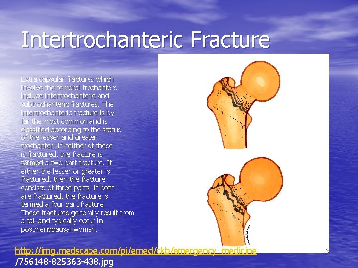 Intertrochanteric Fracture Extra capsular fractures which involve the femoral trochanters include intertrochanteric and subtrochanteric