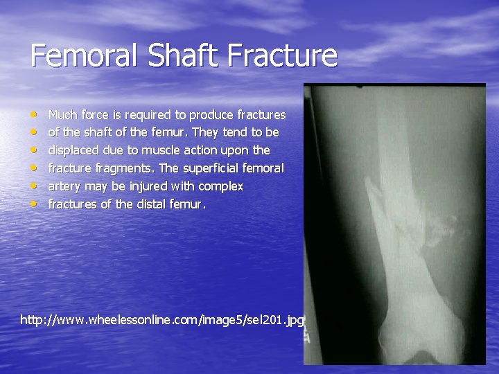 Femoral Shaft Fracture • • • Much force is required to produce fractures of