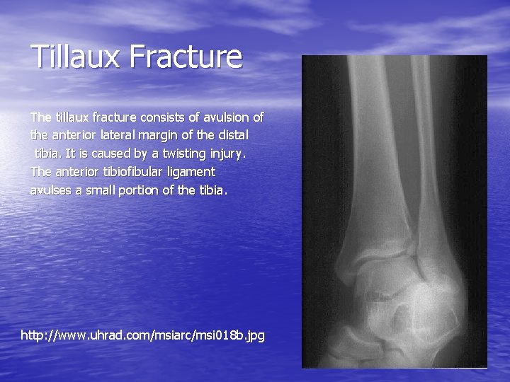 Tillaux Fracture The tillaux fracture consists of avulsion of the anterior lateral margin of