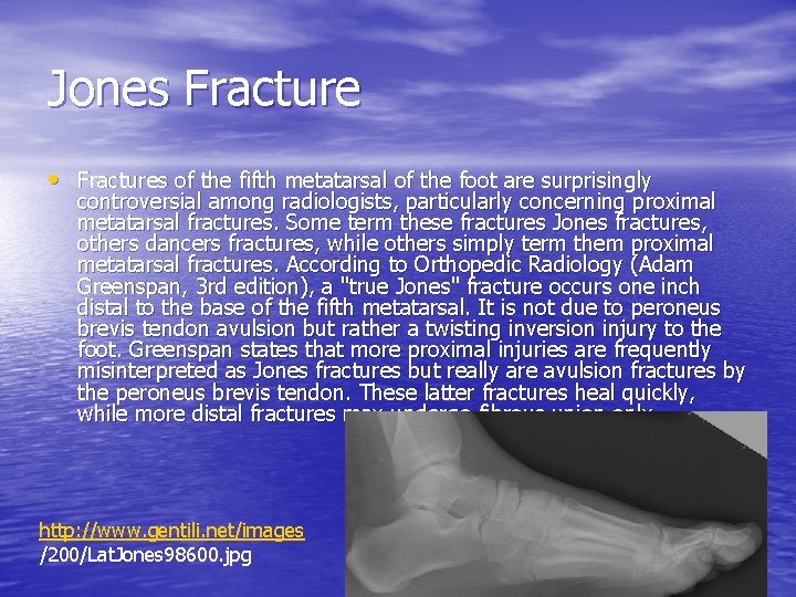 Jones Fracture • Fractures of the fifth metatarsal of the foot are surprisingly controversial