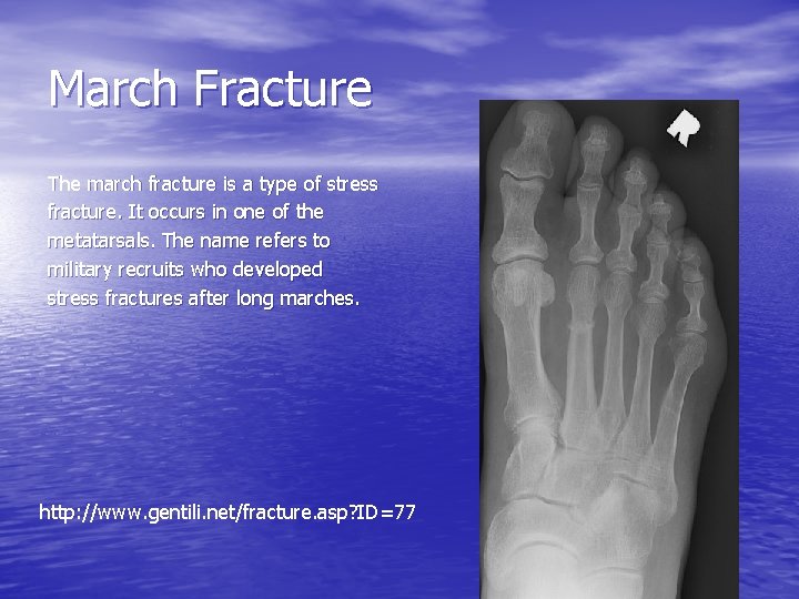 March Fracture The march fracture is a type of stress fracture. It occurs in