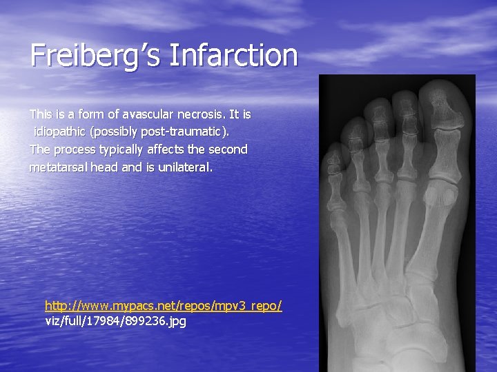 Freiberg’s Infarction This is a form of avascular necrosis. It is idiopathic (possibly post-traumatic).