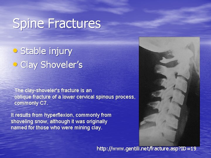 Spine Fractures • Stable injury • Clay Shoveler’s The clay-shoveler's fracture is an oblique