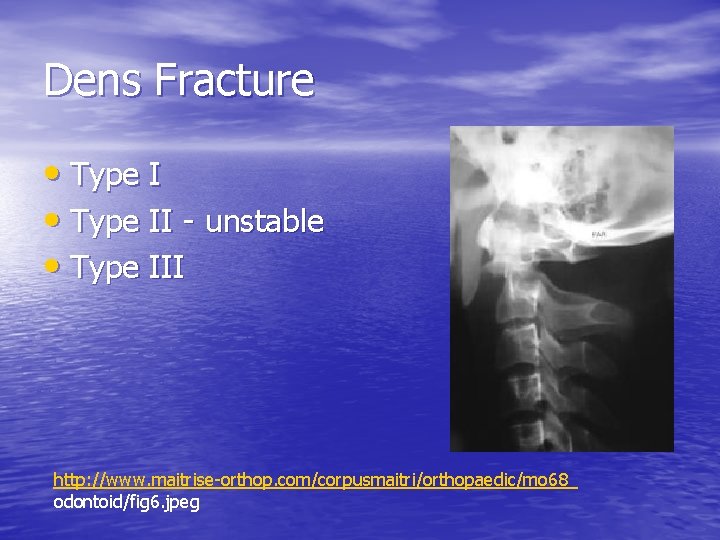 Dens Fracture • Type II - unstable • Type III http: //www. maitrise-orthop. com/corpusmaitri/orthopaedic/mo