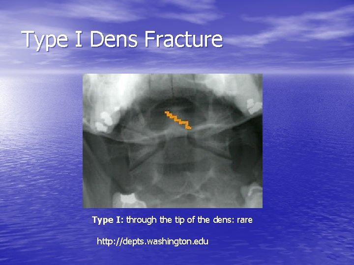 Type I Dens Fracture Type I: through the tip of the dens: rare http: