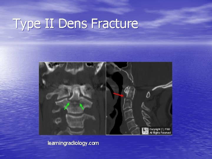 Type II Dens Fracture learningradiology. com 