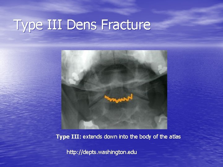 Type III Dens Fracture Type III: extends down into the body of the atlas