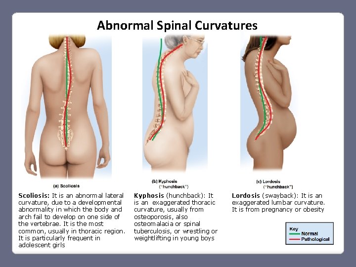 Abnormal Spinal Curvatures Scoliosis: It is an abnormal lateral curvature, due to a developmental