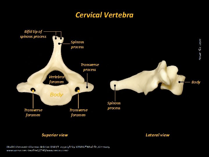 Cervical Vertebra Bifid tip of spinous process Spinous process Transverse process Vertebral foramen Body