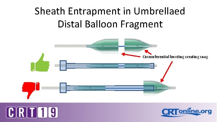 Sheath Entrapment in Umbrellaed Distal Balloon Fragment Circumferential bursting creating snag 