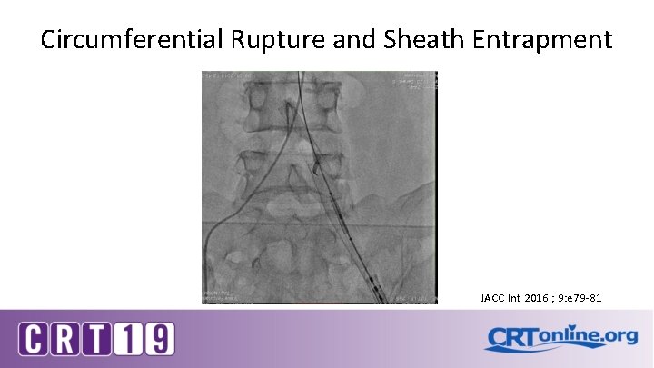 Circumferential Rupture and Sheath Entrapment JACC Int 2016 ; 9: e 79 -81 