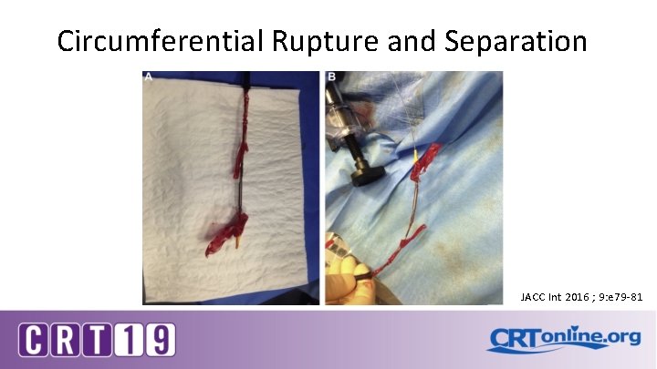 Circumferential Rupture and Separation JACC Int 2016 ; 9: e 79 -81 