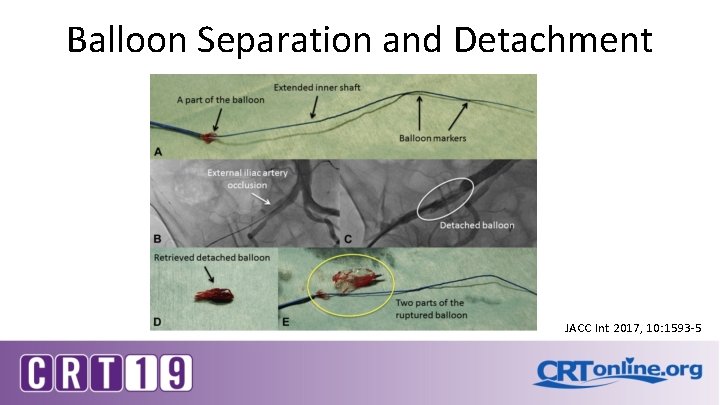 Balloon Separation and Detachment JACC Int 2017, 10: 1593 -5 