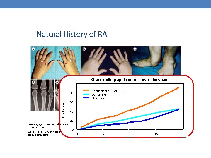 Natural History of RA Sharp radiographic scores over the years 100 Sharp score (JSN