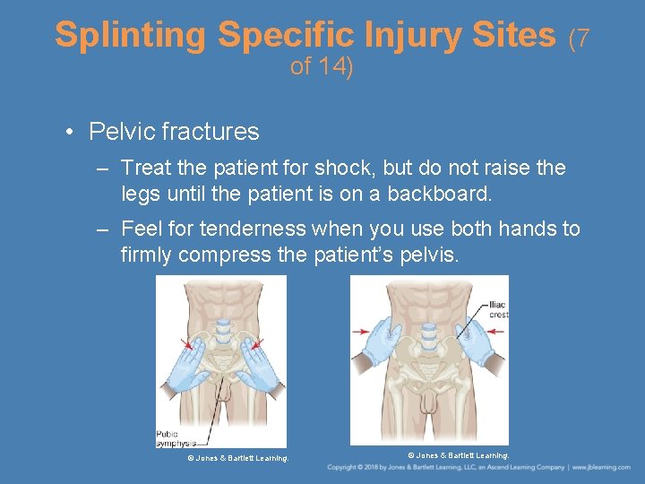 Splinting Specific Injury Sites (7 of 14) • Pelvic fractures – Treat the patient