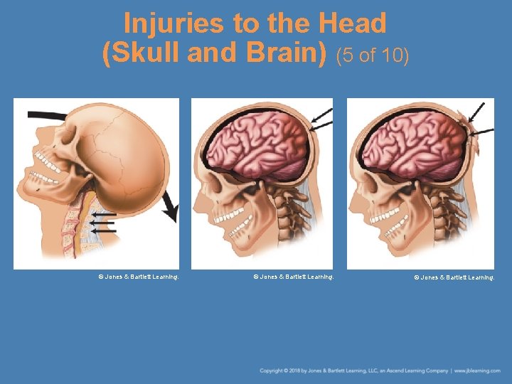 Injuries to the Head (Skull and Brain) (5 of 10) © Jones & Bartlett