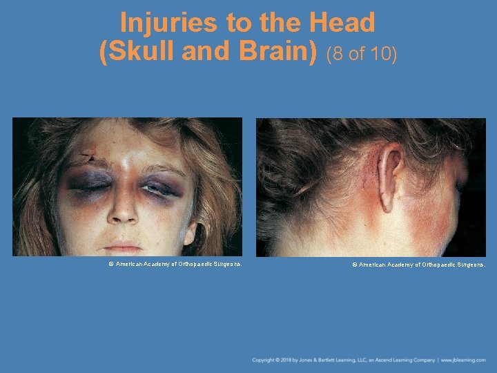 Injuries to the Head (Skull and Brain) (8 of 10) © American Academy of