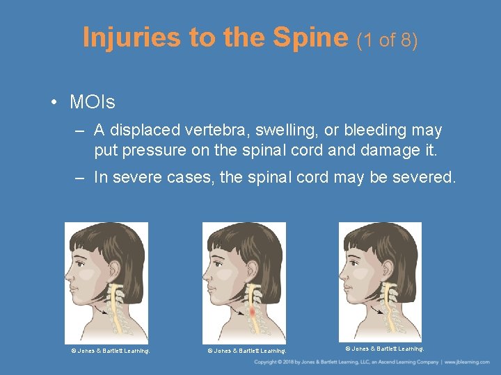 Injuries to the Spine (1 of 8) • MOIs – A displaced vertebra, swelling,