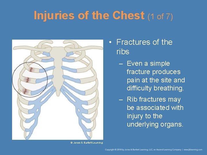 Injuries of the Chest (1 of 7) • Fractures of the ribs – Even