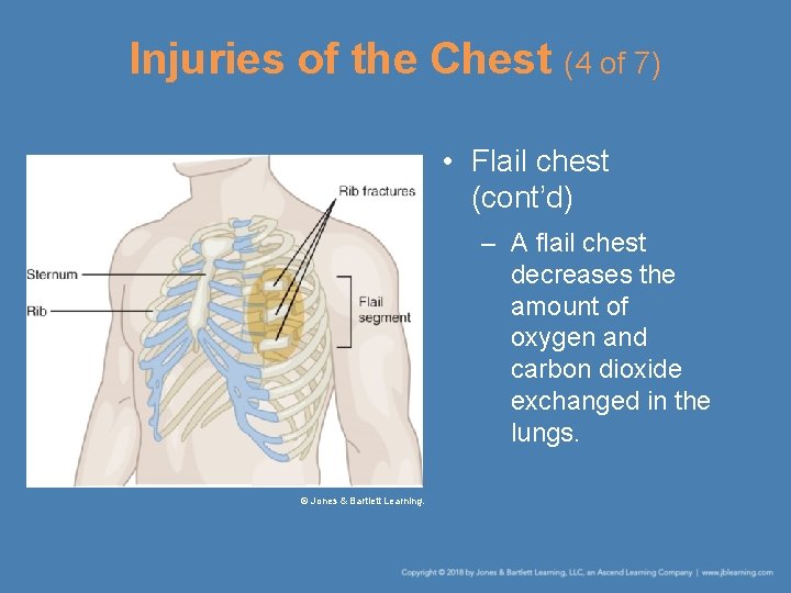Injuries of the Chest (4 of 7) • Flail chest (cont’d) – A flail