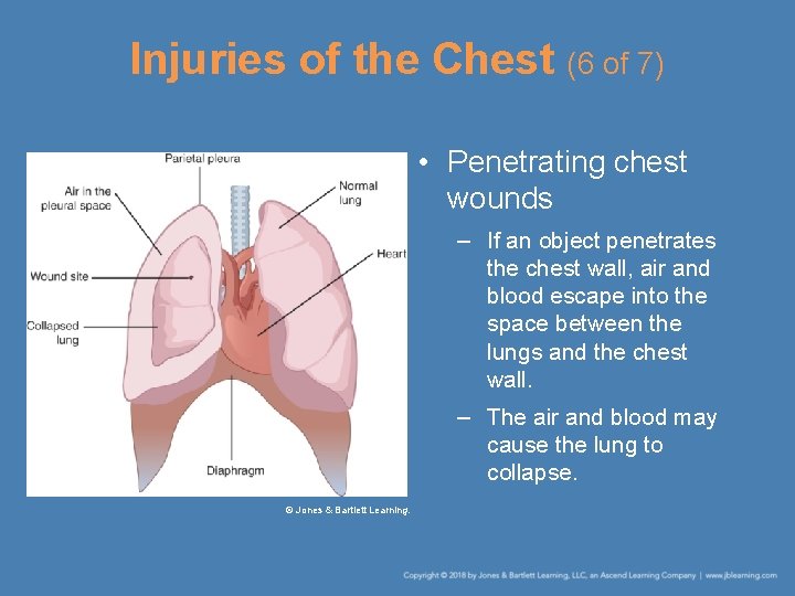 Injuries of the Chest (6 of 7) • Penetrating chest wounds – If an