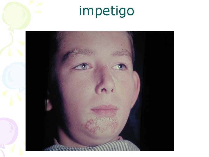 impetigo 