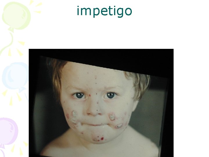 impetigo 