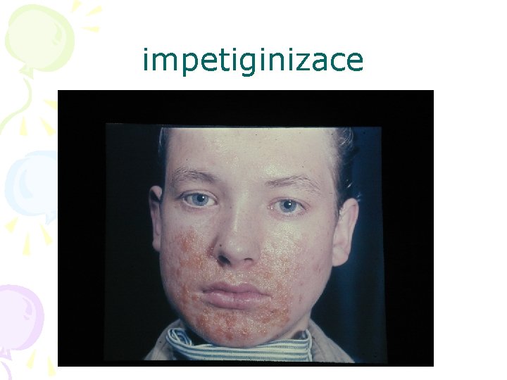 impetiginizace 