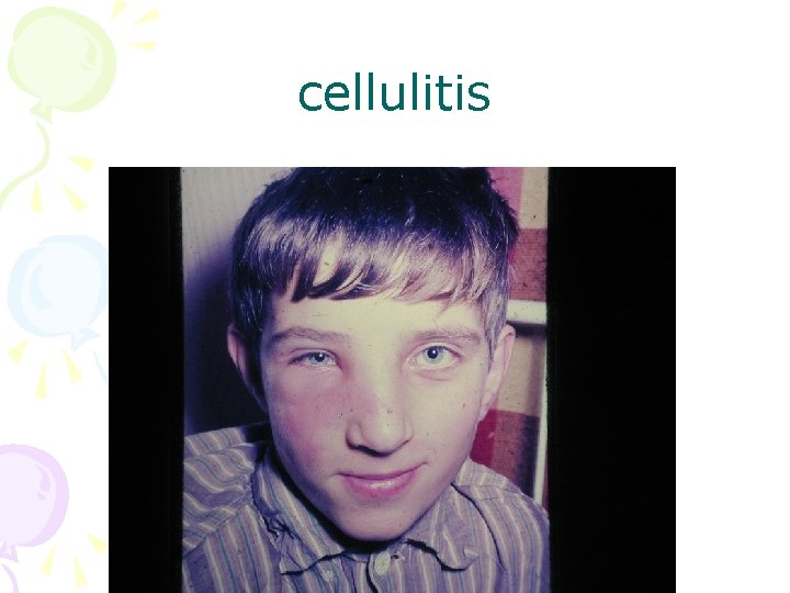 cellulitis 