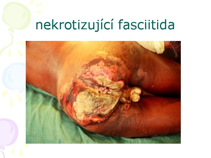 nekrotizující fasciitida 