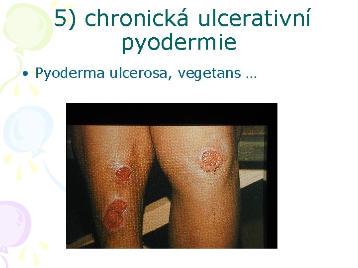 5) chronická ulcerativní pyodermie • Pyoderma ulcerosa, vegetans … 