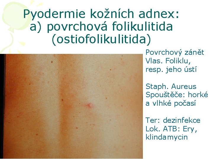 Pyodermie kožních adnex: a) povrchová folikulitida (ostiofolikulitida) Povrchový zánět Vlas. Foliklu, resp. jeho ústí