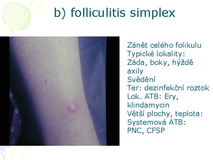b) folliculitis simplex Zánět celého folikulu Typické lokality: Záda, boky, hýždě axily Svědění Ter: