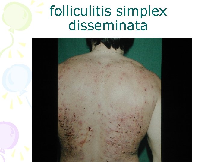 folliculitis simplex disseminata 