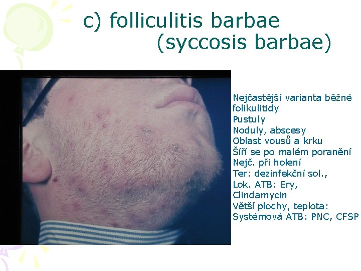 c) folliculitis barbae (syccosis barbae) Nejčastější varianta běžné folikulitidy Pustuly Noduly, abscesy Oblast vousů