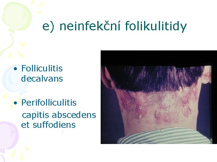 e) neinfekční folikulitidy • Folliculitis decalvans • Perifolliculitis capitis abscedens et suffodiens 