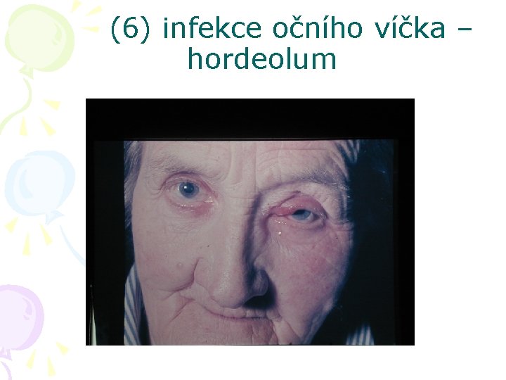 (6) infekce očního víčka – hordeolum aritis ion 
