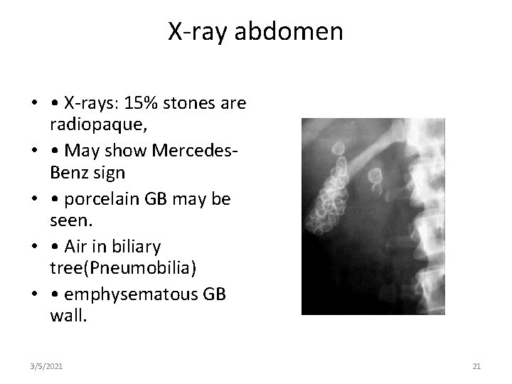 X-ray abdomen • • X-rays: 15% stones are radiopaque, • • May show Mercedes.