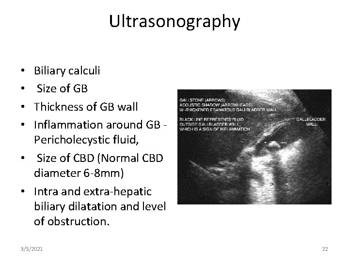 Ultrasonography Biliary calculi Size of GB Thickness of GB wall Inflammation around GB Pericholecystic
