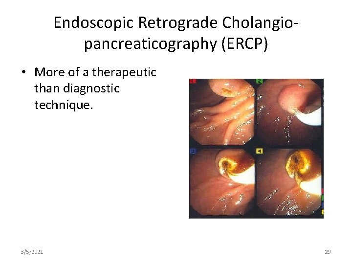 Endoscopic Retrograde Cholangiopancreaticography (ERCP) • More of a therapeutic than diagnostic technique. 3/5/2021 29