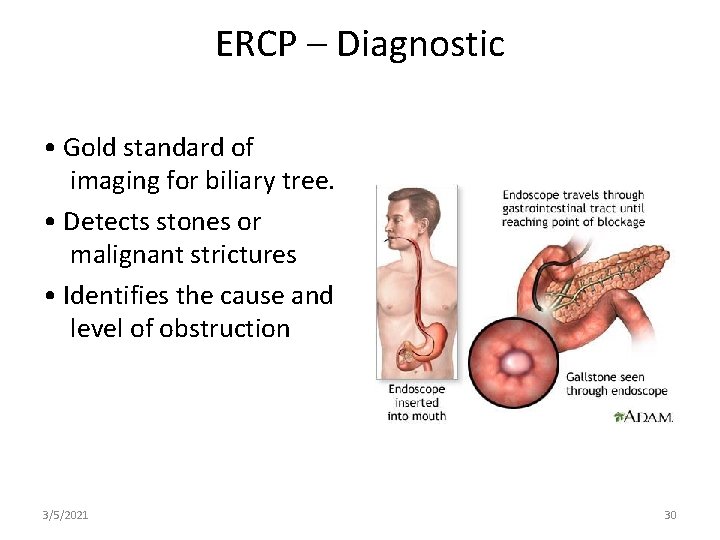 ERCP – Diagnostic • Gold standard of imaging for biliary tree. • Detects stones