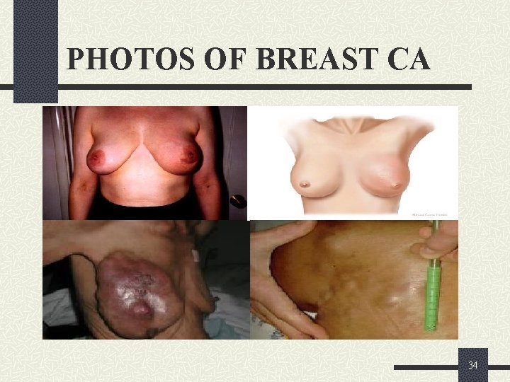 PHOTOS OF BREAST CA 34 