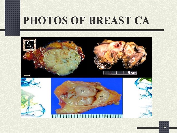 PHOTOS OF BREAST CA 36 