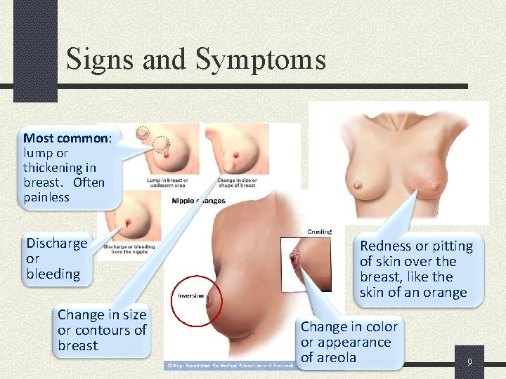 Signs and Symptoms Most common: lump or thickening in breast. Often painless Discharge or