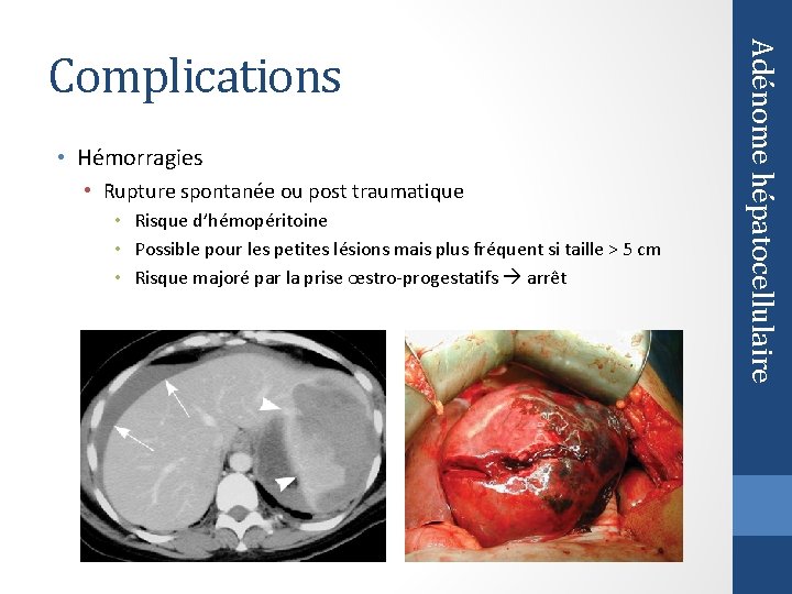  • Hémorragies • Rupture spontanée ou post traumatique • Risque d’hémopéritoine • Possible